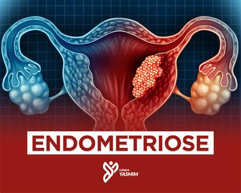 tudo sobre a endometriose